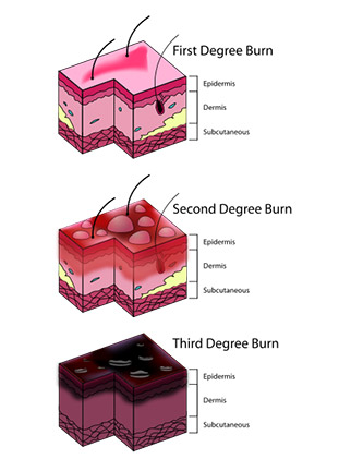 Burns can range in severity from mild to extremely severe. Houston burn injury lawyers can get you the medical care you need and provide you with legal advice when you need it most.